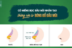 Miếng bọc sụn mũi nhân tạo có thay thế được sụn tai không?